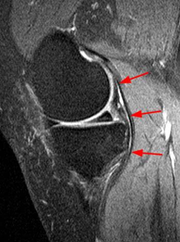 Proximal Gastrocnemius Tendon Pathology - Radsource